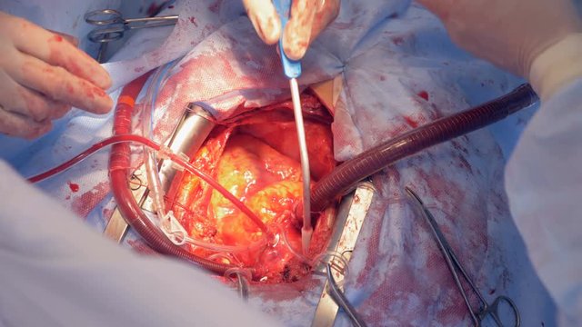 Process of a heart surgery during which it is being adjusted