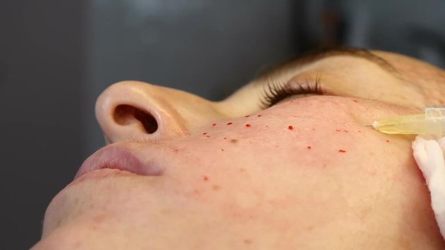 Cosmetician in gloves making face lifting injection. female client gets facial beauty procedure in healthcare clinic. liquid thread injection. Botox. collagen