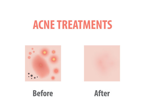 Acne treatments diagram illustration vector on white background, Beauty concept.