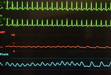 Supraventricular Tachycardia on Monitor in Green, arterial blood pressure in red and oxygen...