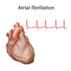 Human heart. Atrial fibrillation. Anatomy illustration. Red image, white background. Heartbeat, pulse, ecg.