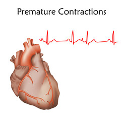 Human heart. Premature Contractions. Anatomy illustration. Red image, white background. Heartbeat, pulse, ecg.