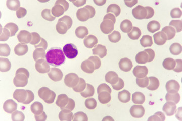 Lymphocyte cells (white blood cell) in blood smear, analyze by microscope
