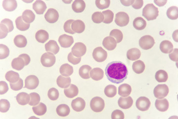 Lymphocyte cell (white blood cell) in blood smear, analyze by microscope
