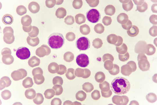 Blood smear of chronic lymphocytic leukemia (CLL), analyze by microscope
