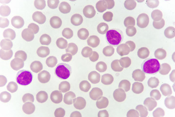 Blood smear of chronic lymphocytic leukemia (CLL), analyze by microscope
