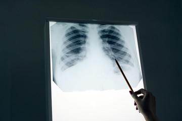 Woman doctor hand examining a lung radiography x-ray, result from x-ray machine. Check the cancer progress. Doctor concept.