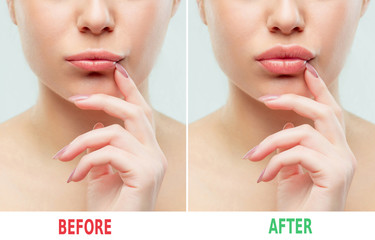 Before and after lips filler injections. Beauty plastic. Beautiful perfect lips with natural makeup.