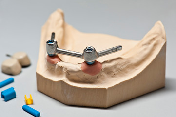 Dental implant teeth on skeletal mandible support.