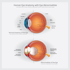 Eye Anatomy with Eye Abnormalities Vector Illustration
