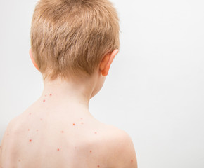child with varicella