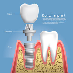 Fototapeta premium Human teeth and Dental implant Vector Illustration