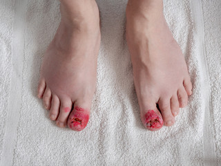 Toes after ingrown nail surgery. Convalescent appearance without nails with stitches, disinfectant...