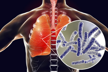 Legionella pneumophila bacteria in human lungs, 3D illustration, the causative agent of Legionnaire's disease