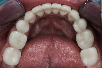 Obraz premium ceramic teeth after fixation