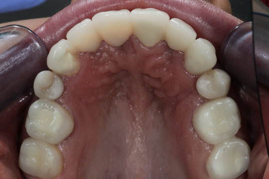 ceramic crowns and restoration, final photo after fixation