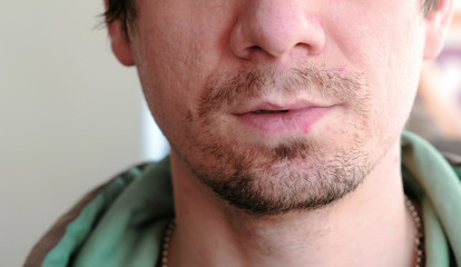 Obraz premium Herpes. Lip treatment. Close-up of the man's lips with herpes. Front view.