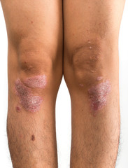 Psoriasis that knee on white background