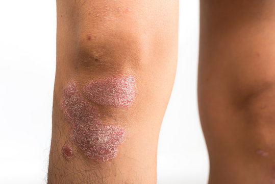 Psoriasis that knee on white background