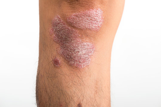 Psoriasis that knee on white background