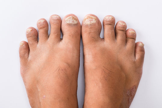 Psoriasis that Pedicure on white background
