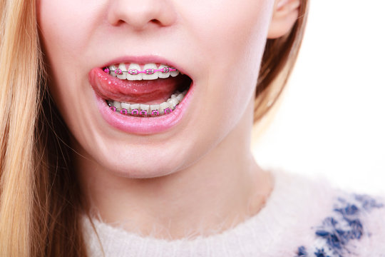 Happy woman showing her braces on teeth