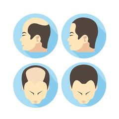 Male hair loss stages set. Man before and after hair treatment and hair transplantation. Male pattern baldness. Transplantation of hair. illustration.
