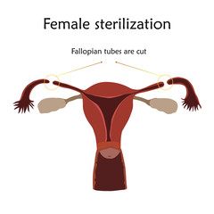 Sterilization. Human realistic uterus. Anatomy flat illustration with specification. Colored image, white background. Gynecological diseases.