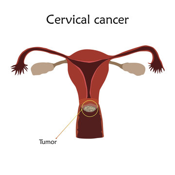 Cervical cancer. Human realistic uterus. Anatomy flat illustration with specification. Colored image, white background. Gynecological diseases.