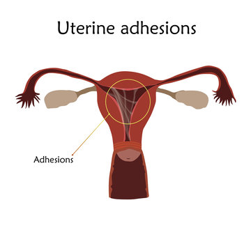 Uterine adhesions. Human realistic uterus. Anatomy flat illustration with specification. Colored image, white background. Gynecological diseases.
