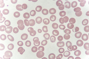 Target cells with abnormal red blood cells from anemia patient, analyze by microscope