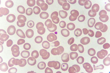 Target cells with abnormal red blood cells from anemia patient, analyze by microscope