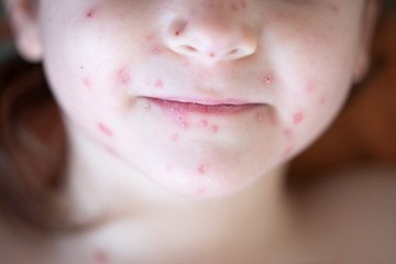 Chickenpox on the body of a little girl