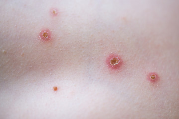 Chickenpox on the body of the little child