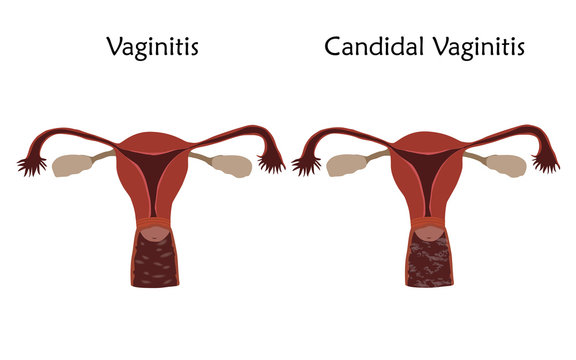 Vaginitis and candidal vaginitis. Human realistic uterus. Anatomy flat illustration. Colored image, white background. Gynecological diseases.