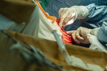 removal of a malignant tumor