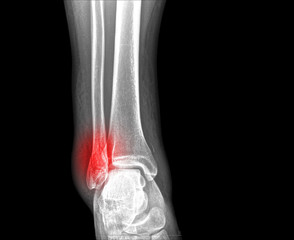 x-ray of ankle fracture