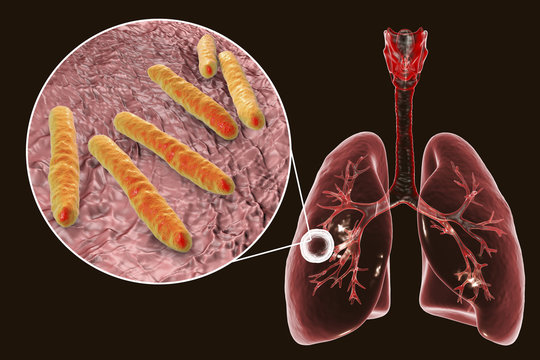 Fibrous-cavernous pulmonary tuberculosis and close-up view of Mycobacterium tuberculosis bacteria, 3D illustration showing cavity in the lung