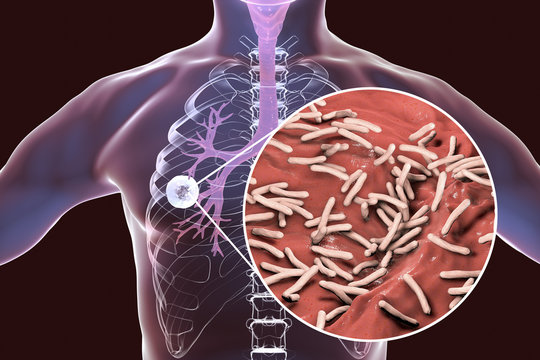 Fibrous-cavernous pulmonary tuberculosis and close-up view of Mycobacterium tuberculosis bacteria, 3D illustration showing cavity in the lung