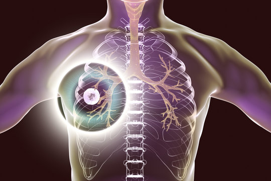 Fibrous-cavernous pulmonary tuberculosis, 3D illustration showing tuberculosis cavity in the lung