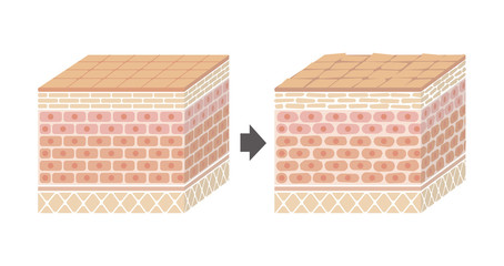 Sectional view of the skin.Comparison illustration of healthy skin and wounded skin. 