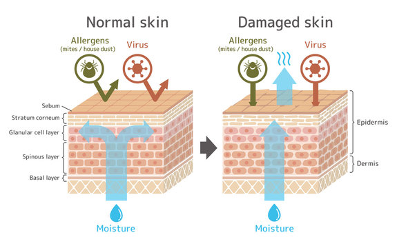 Sectional view of the skin.Comparison illustration of protection effect between healthy skin and wounded skin. With text. 