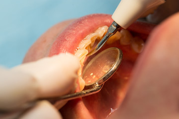 A dentist makes teeth to a woman