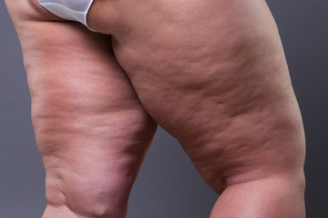 Fat female body with cellulite, overweight hips and legs