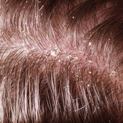 Dandruff on male dark hair
