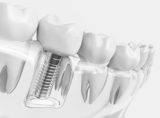 Tooth human implant  - obrazy, fototapety, plakaty