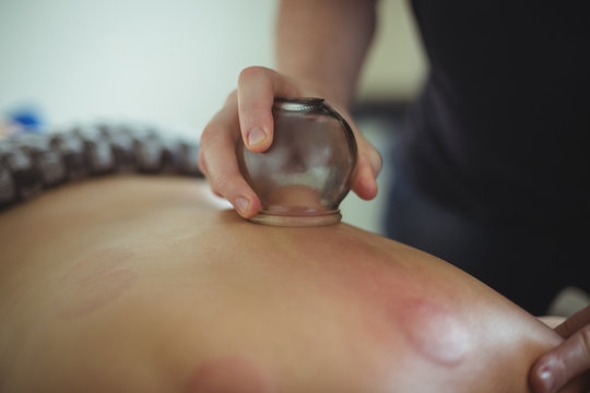 Mid section of therapist giving cupping therapy to man