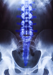 X-ray of the pelvis and spinal column
