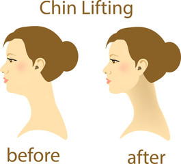 Illustration of a woman with a double chin and a normal chin surgery