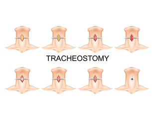 tracheostomy tube. surgery